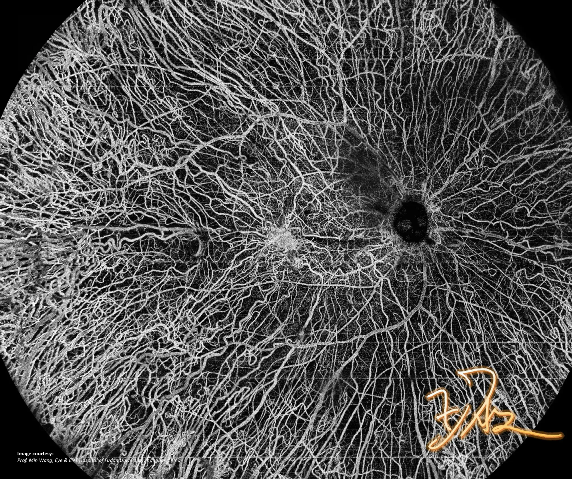 Choroideremia — obraz OCTA