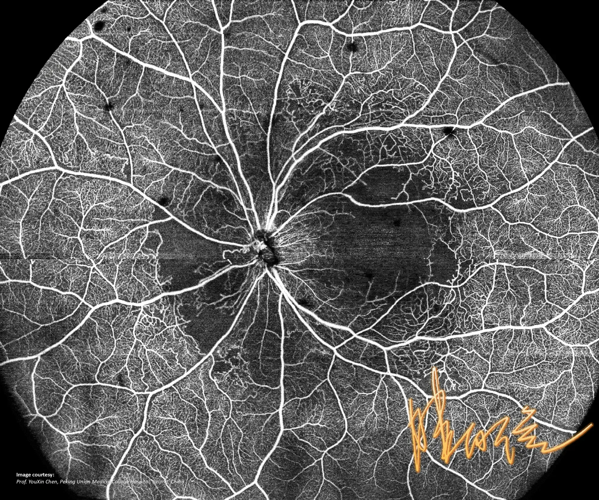 Retinopatia typu Purtschera (aHUS) — obraz OCTA