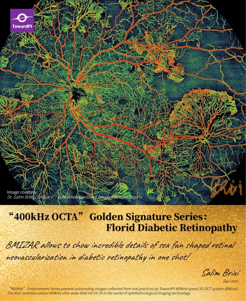 SS-OCTA 400 kHz BMizar: neowaskularyzacja siatkówki w retinopatii cukrzycowej