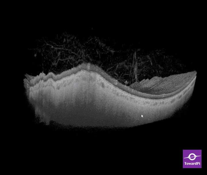 Rekonstrukcja 3D mętów ciała szklistego w SS-OCT (animacja)