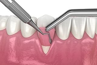 Dental laser reshaping the gumline
