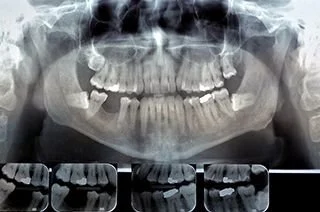 Digital panoramic X-ray showing the teeth and jaw