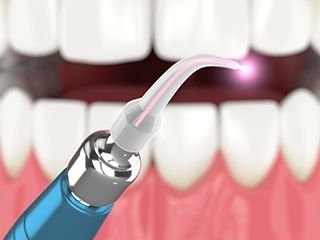 Dental laser being used to treat gum tissue