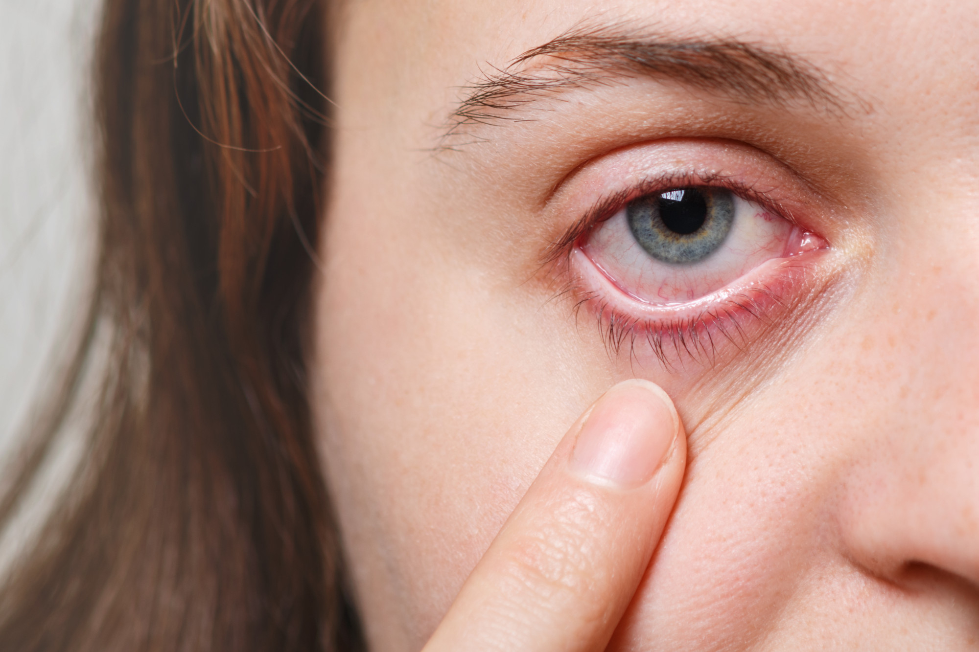 Close-up of a person's blue eye with redness and visible blood vessels, gently pulling down lower eyelid with finger.