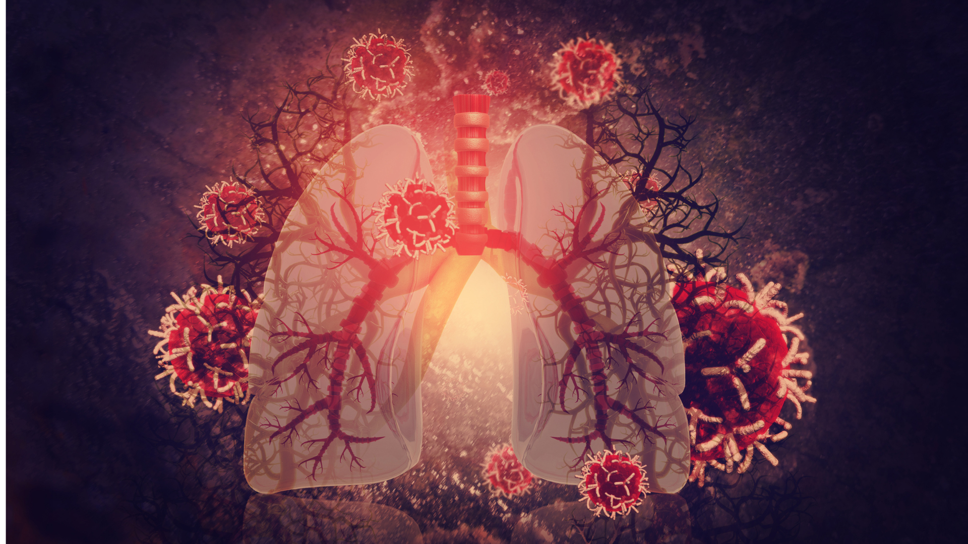 Legionnaires’ Disease