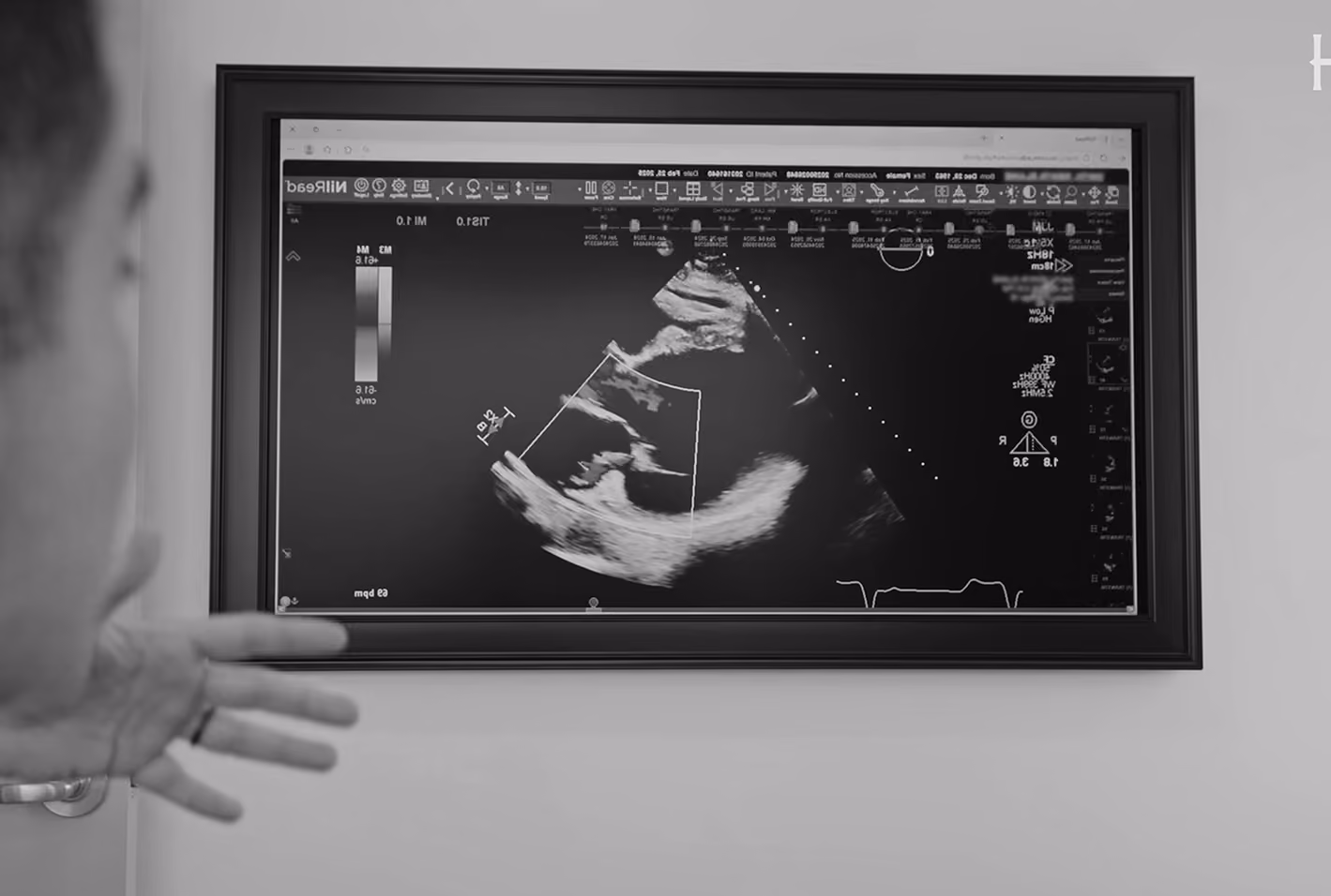 Echocardiogram on a monitor at California Heart & Health