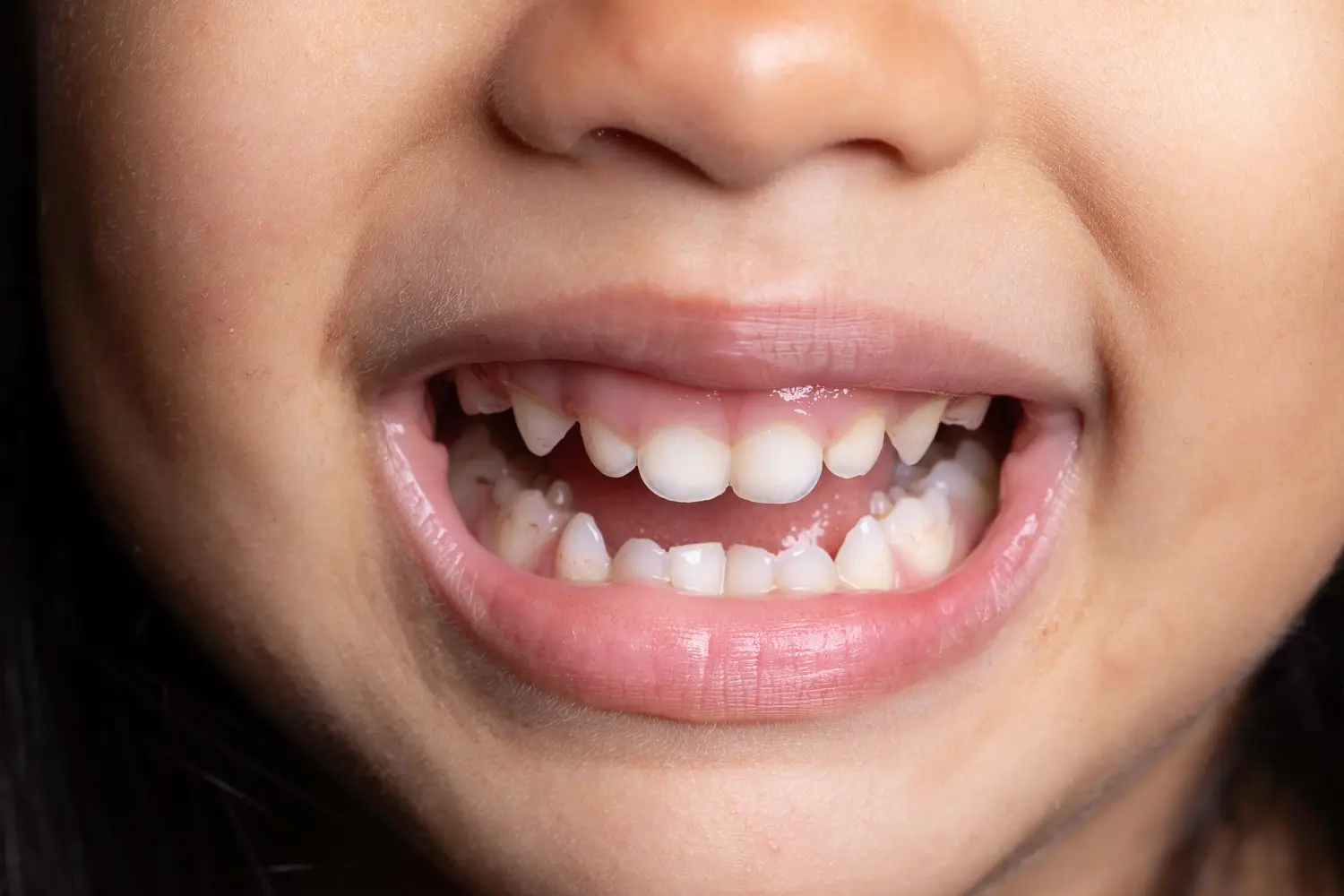 Pediatric Dentistry - Restorative Dentistry