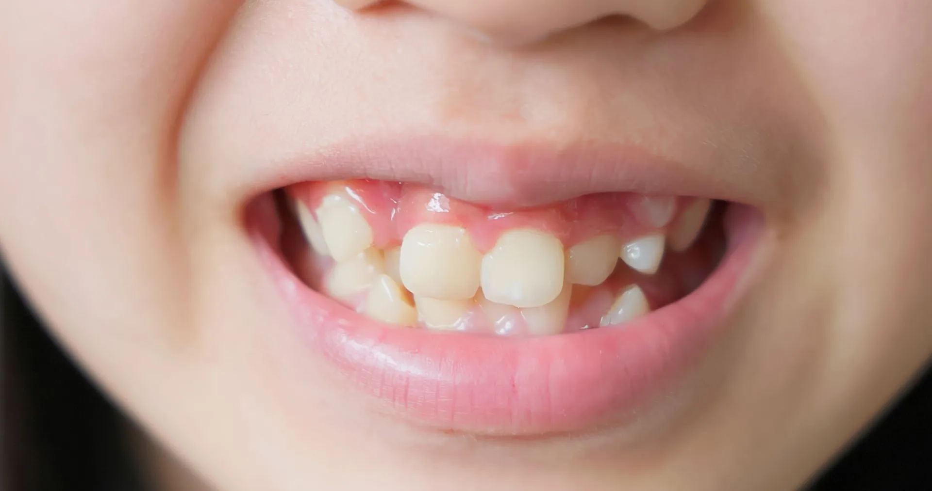 Close-up of crooked, crowded front teeth