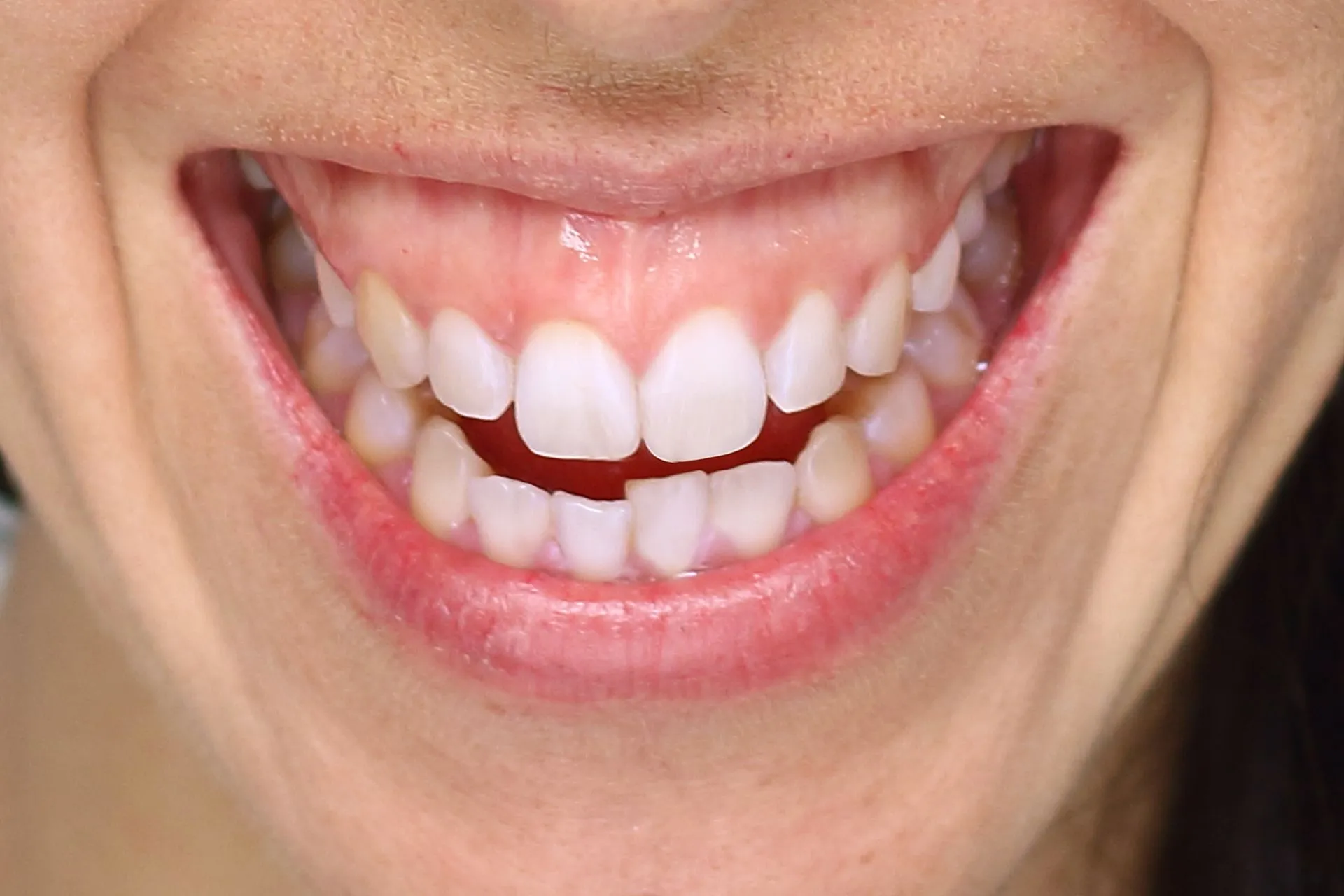 Close-up of a smile showing excess gum tissue above the upper teeth