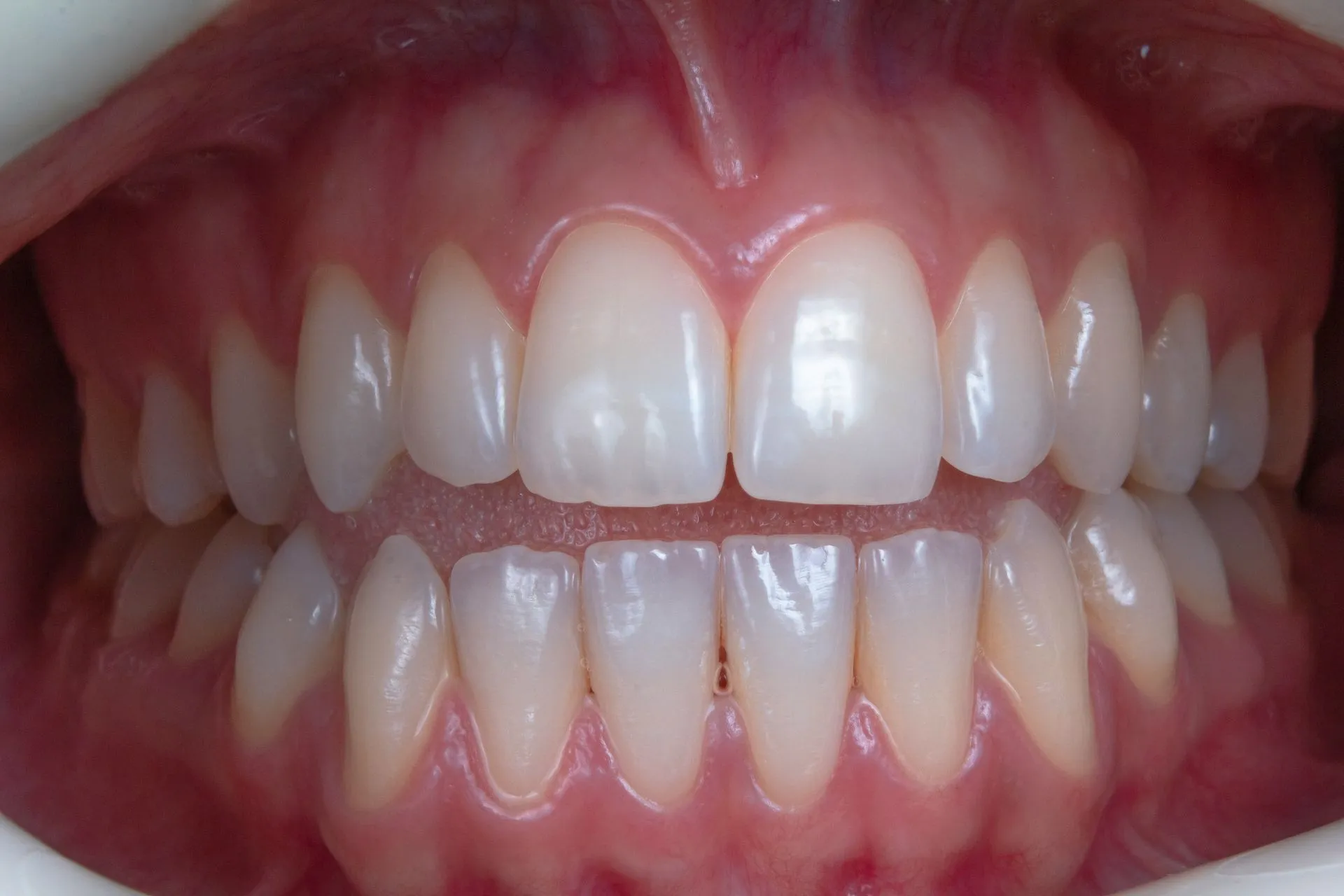 Close-up of upper and lower front teeth after orthodontic treatment