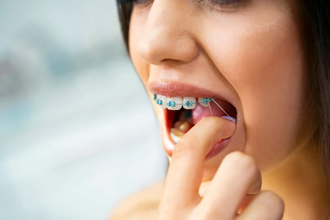 Woman placing an orthodontic rubber band on her braces