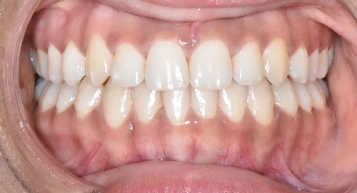 Close-up of a patient's teeth after braces removal, showing their smile without brackets or wires.