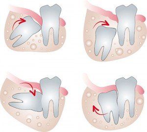 Wisdom Tooth — Wilmington, DE — New Concept Dental
