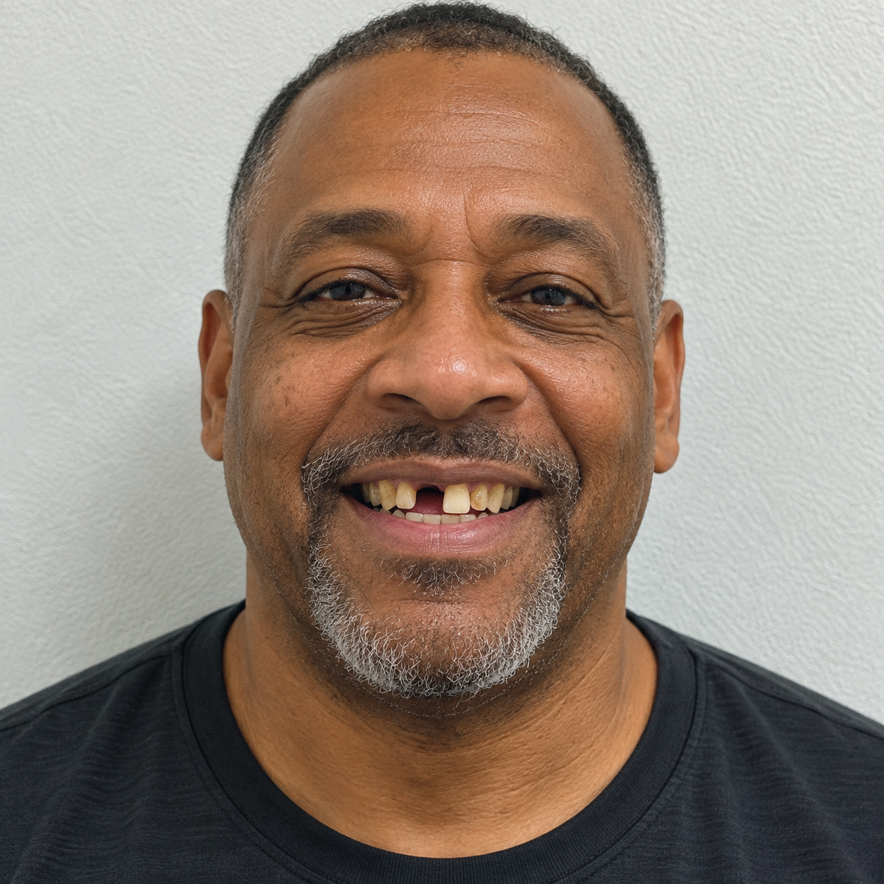 African American man in his 50s smiling with visible gaps, missing teeth, and discoloration before dental treatment.