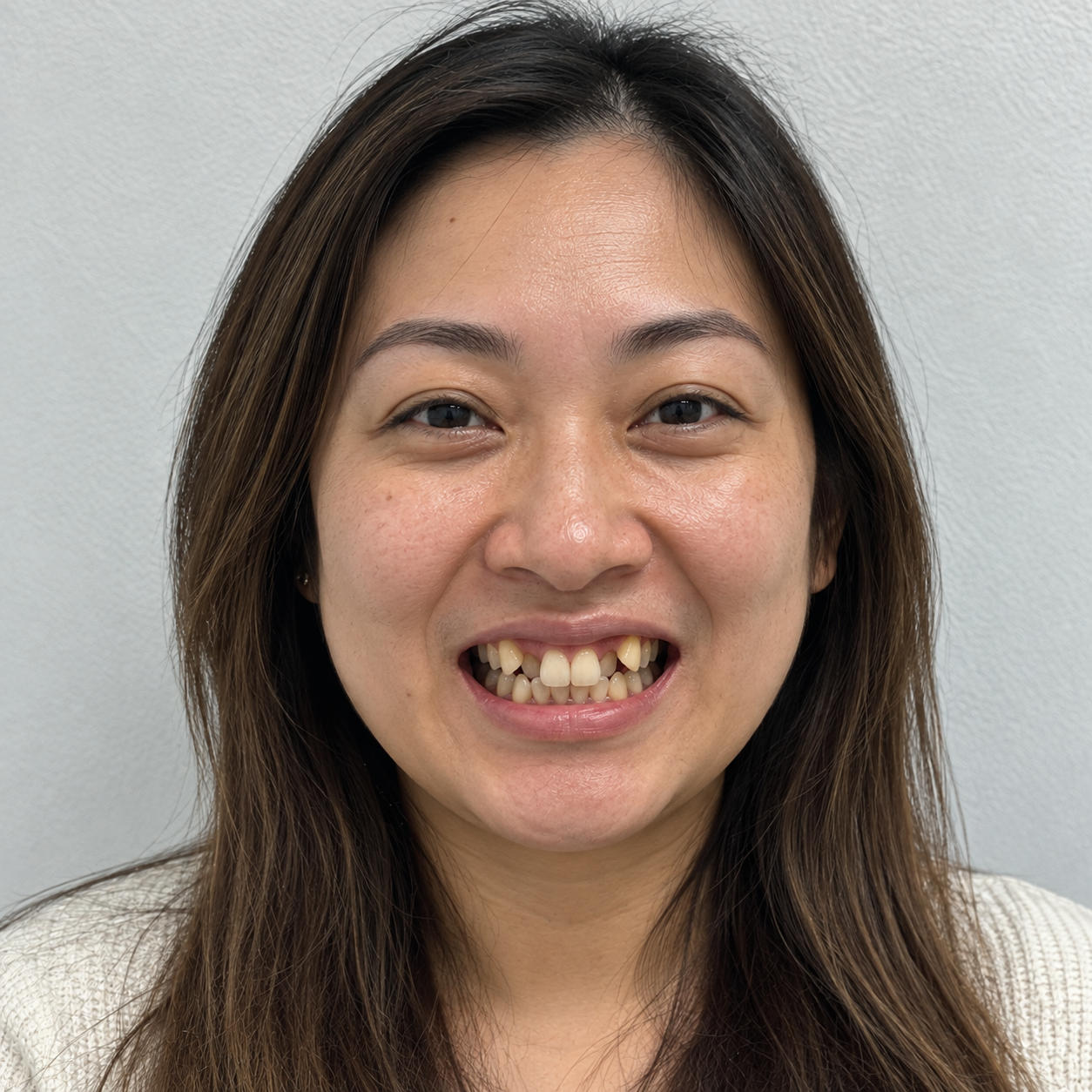 Asian woman in her 30s smiling with visibly crooked, crowded, and discolored teeth before dental treatment.