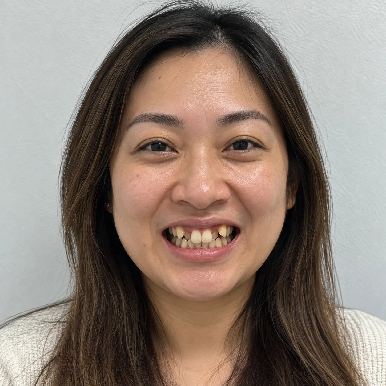 Asian woman in her 30s smiling with visibly crooked, crowded, and discolored teeth before dental treatment.