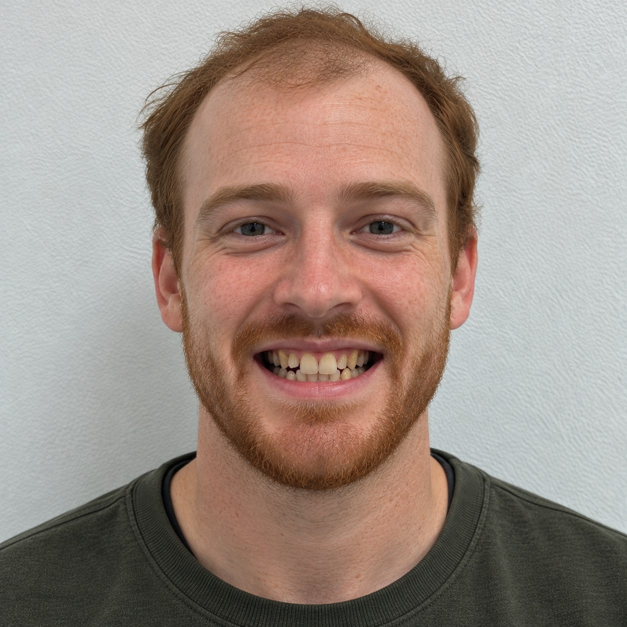 Redheaded man in his 20s with a receding hairline smiling with visibly crooked, uneven, and discolored teeth before dental treatment.
