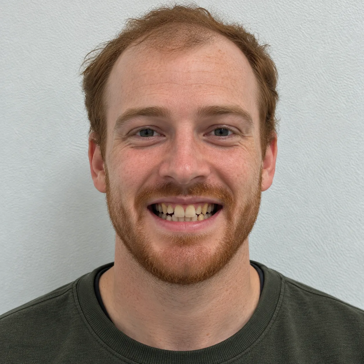 Redheaded man in his 20s with a receding hairline smiling with visibly crooked, uneven, and discolored teeth before dental treatment.