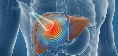 Illustrated anatomical torso scan showing a targeted energy beam focused on the liver during Velacur elastography