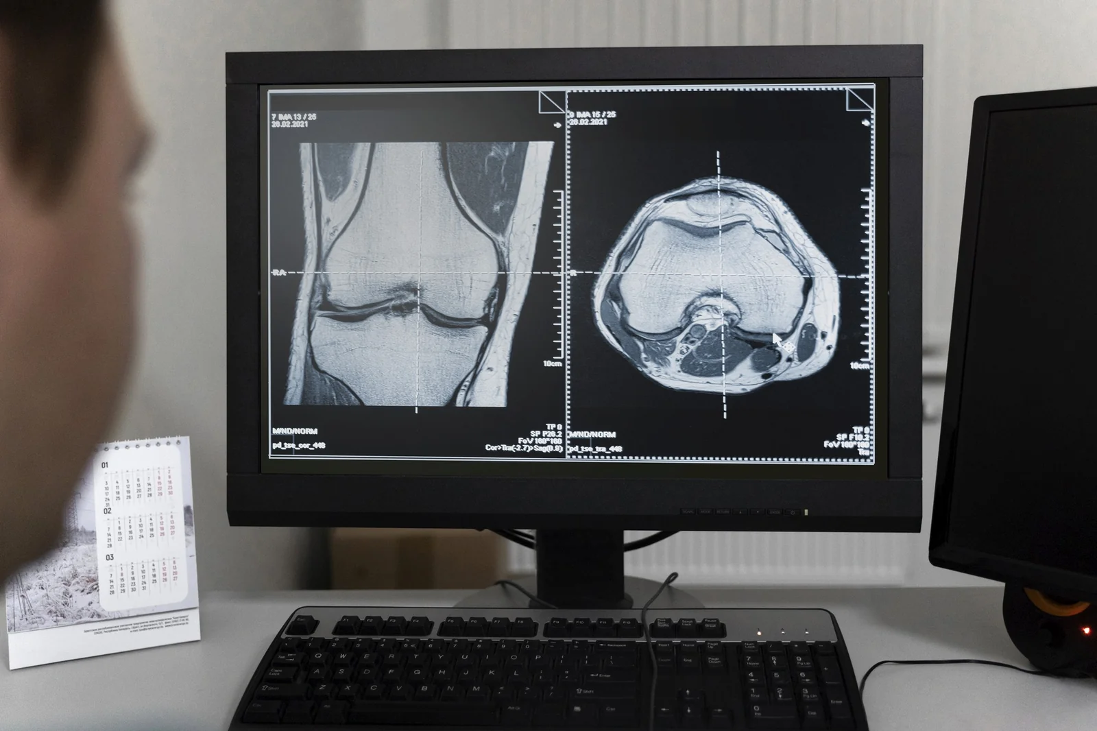 Knee MRI scans displayed on a radiology workstation