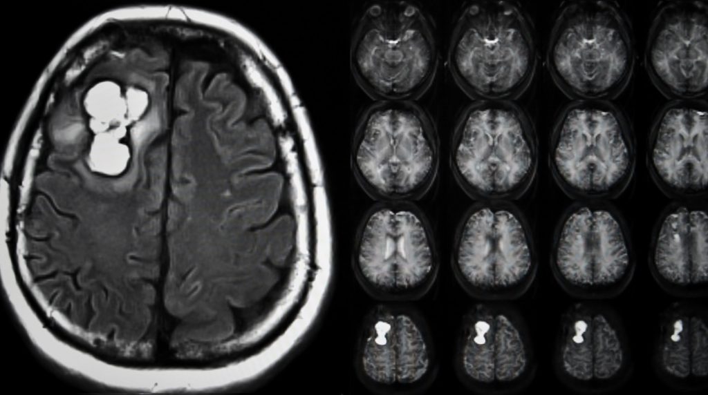 Agytumor képe az MRI-n