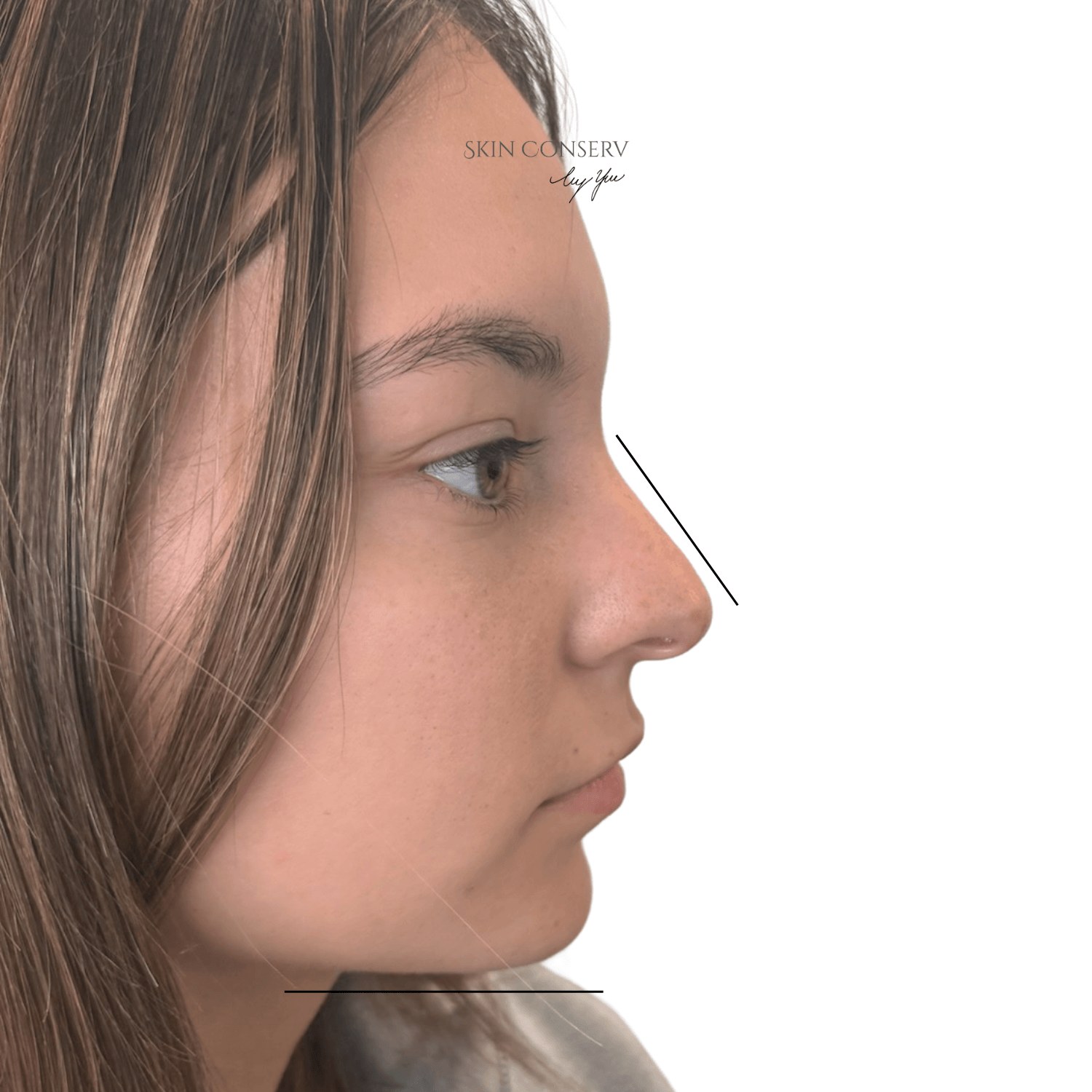 Before micro-architecture balancing filler, front view, Skin Conserv by Yve