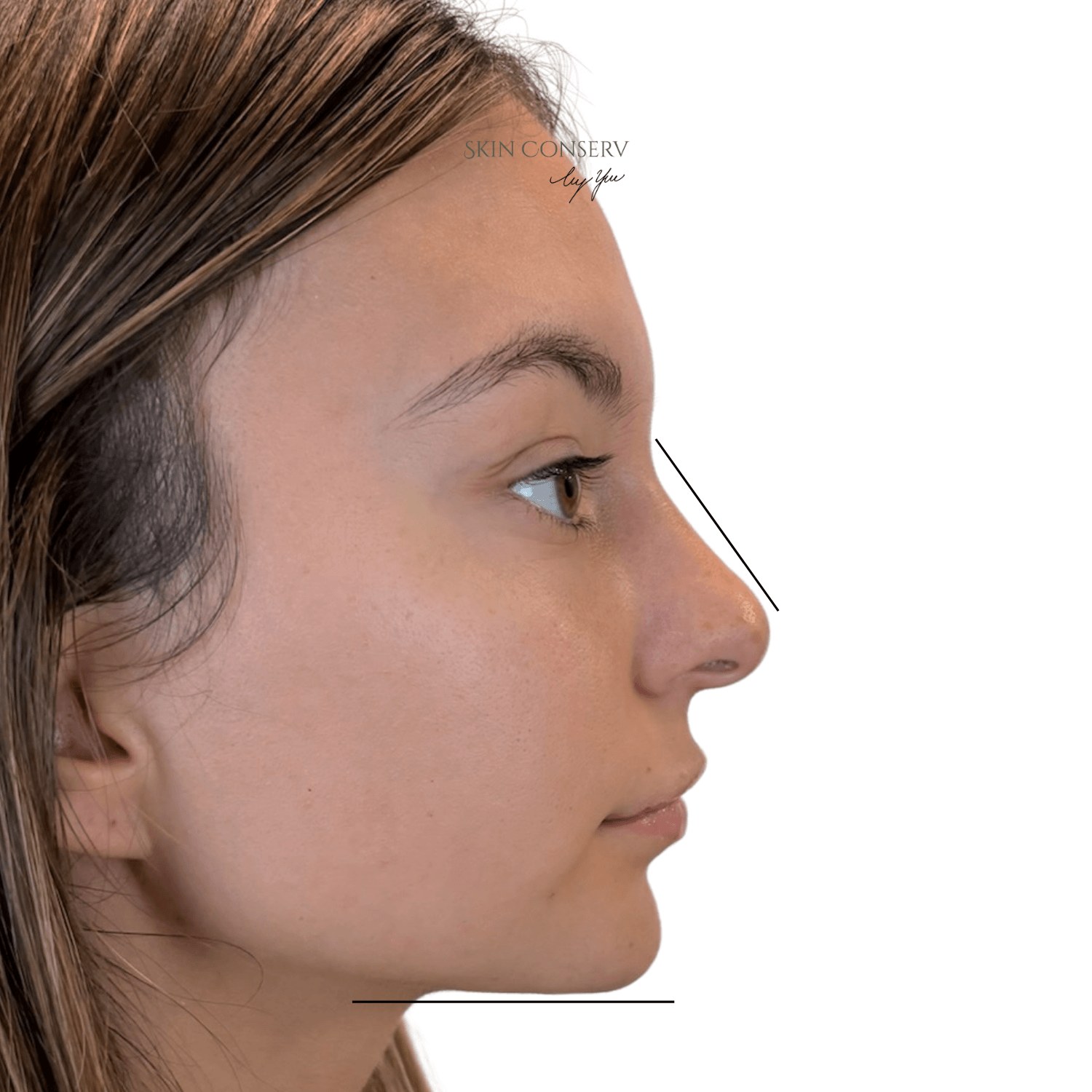 After micro-architecture balancing filler, front view, Skin Conserv by Yve