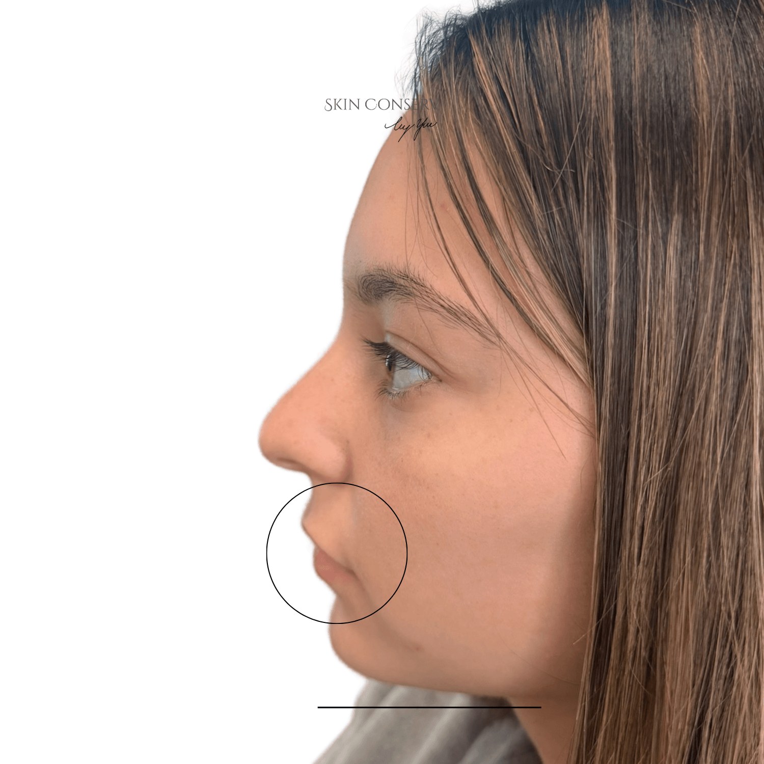 Before profile balancing filler, side view, Skin Conserv by Yve