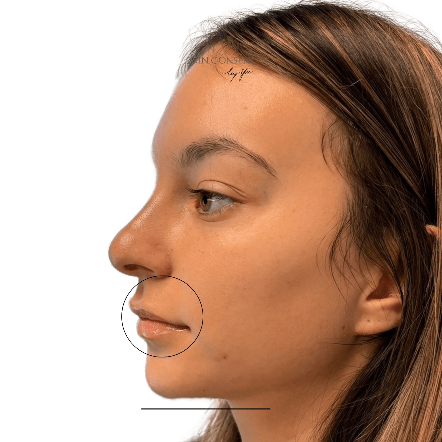 After profile balancing filler, side view, Skin Conserv by Yve
