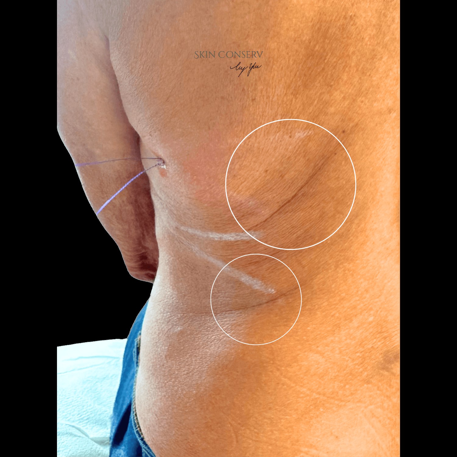 Before PDO thread lift on the body, Skin Conserv by Yve