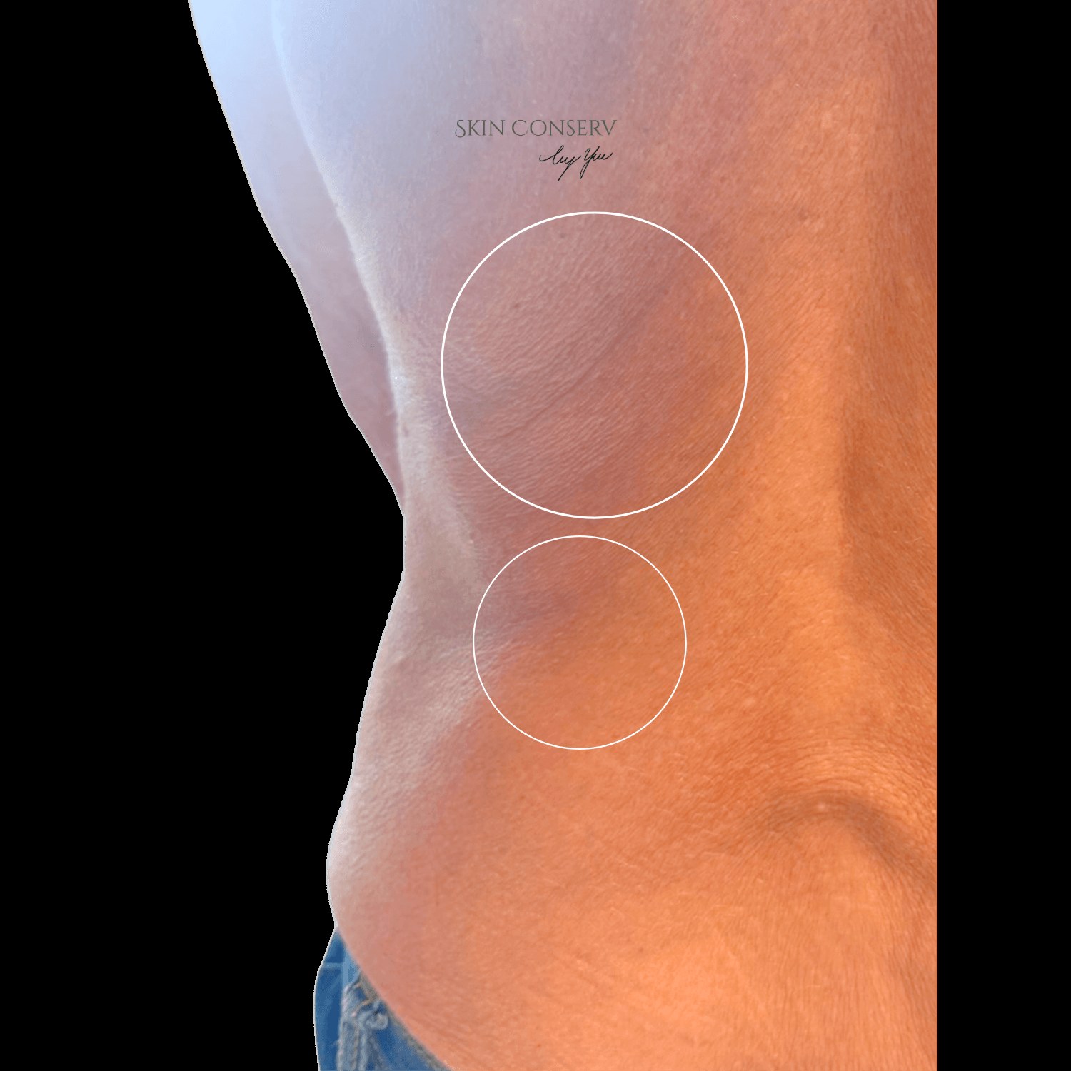 After PDO thread lift on the body, Skin Conserv by Yve