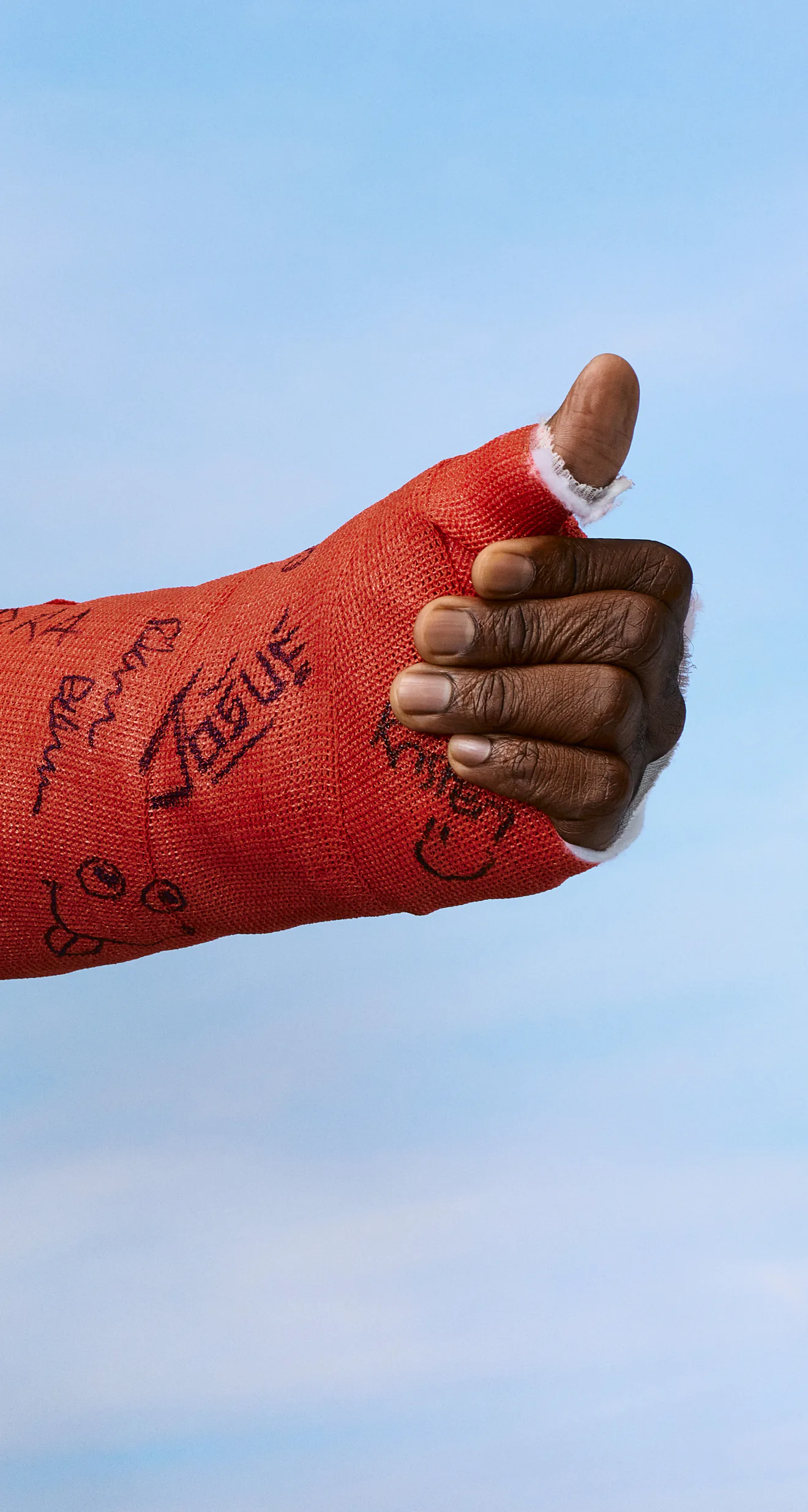 An arm in a red cast covered in signatures, giving a thumbs-up against a blue sky