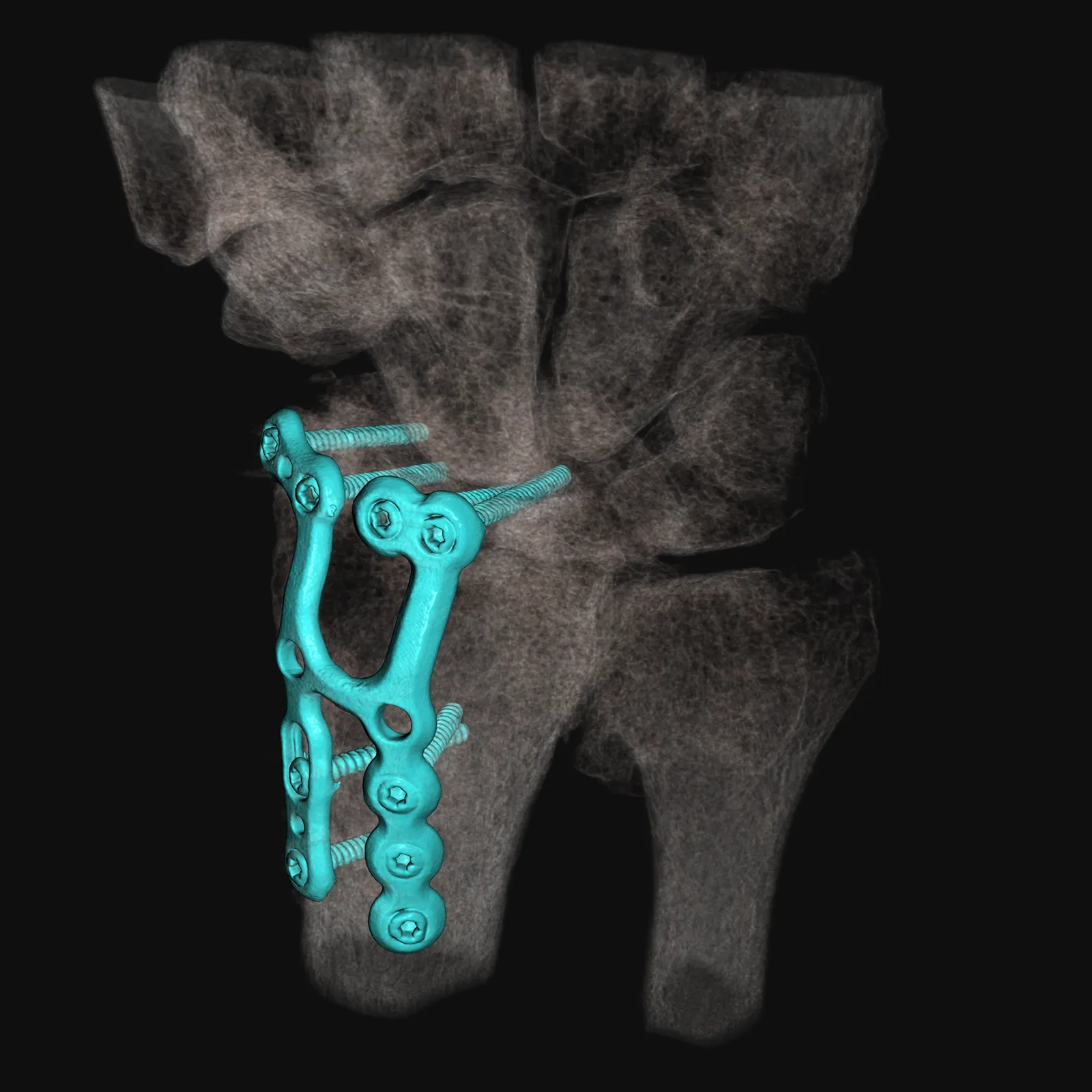 Bone hardware