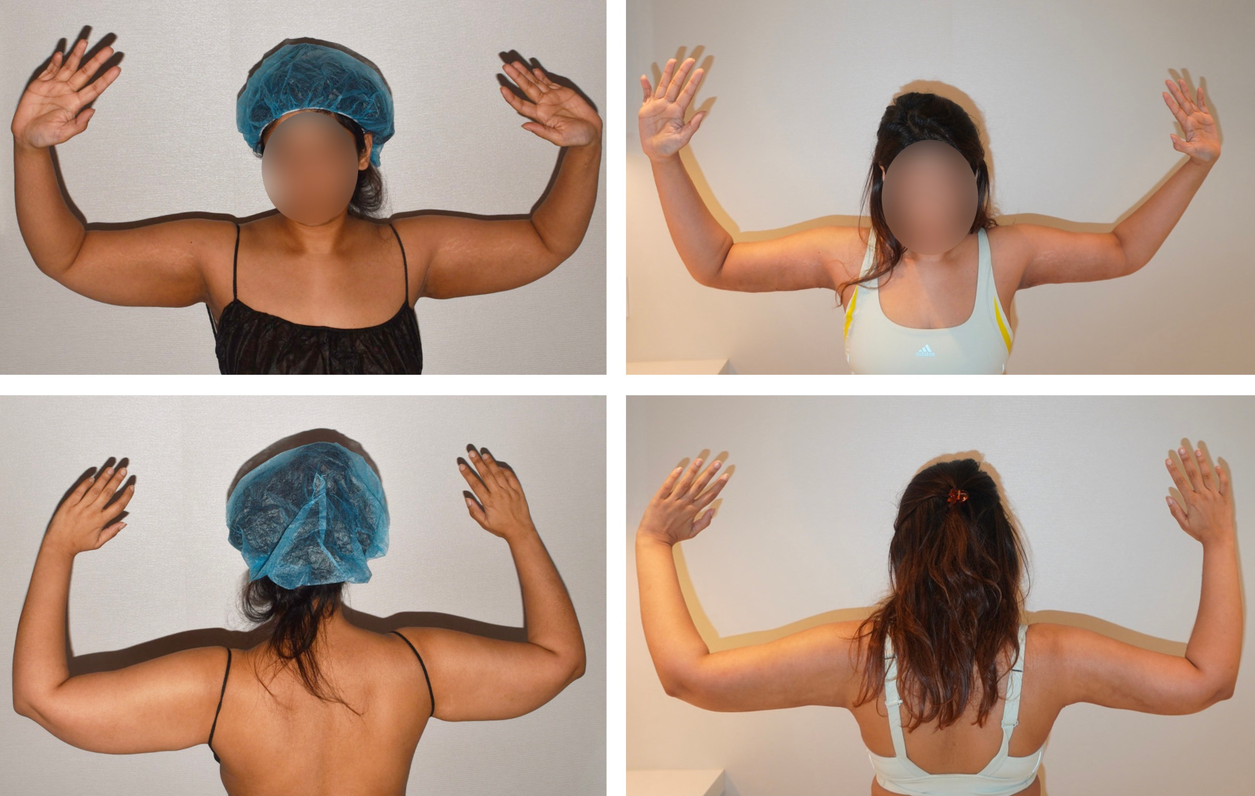 Arm lift before and after photographs, patient 3
