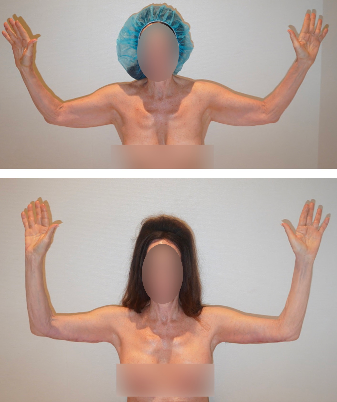 Arm lift before and after photographs, patient 2