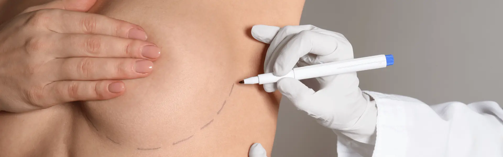 Gloved clinician marking the breast with a pen, from the original Implant Revision page