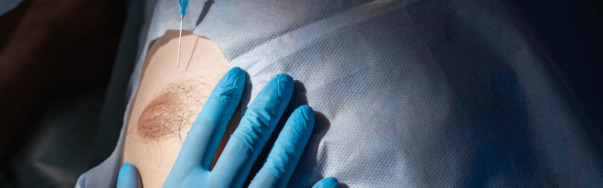 Gloved hand beside an areola during a clinical procedure