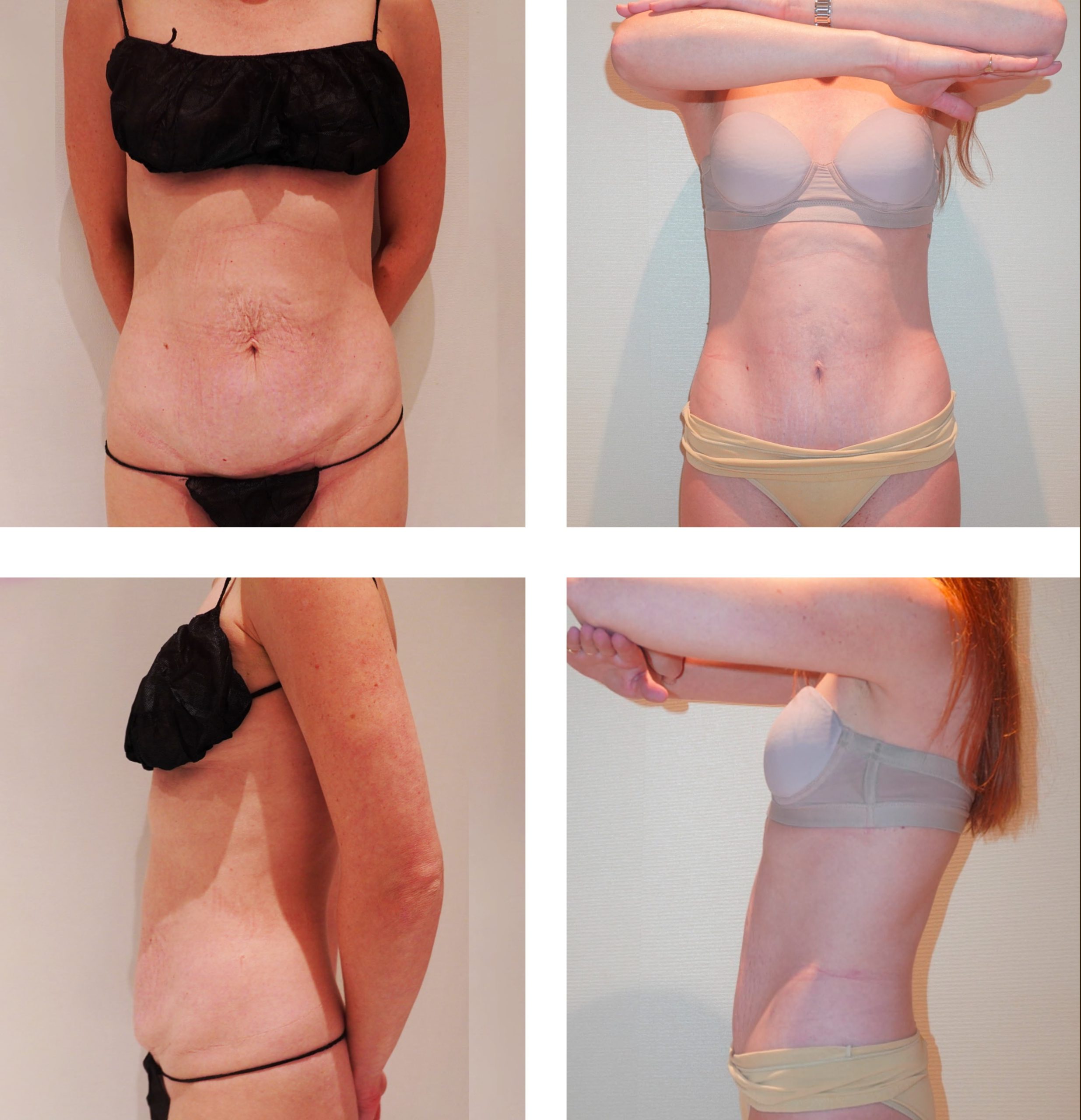 Before and after hybrid abdominoplasty (mini tummy tuck plus BodyTite), case 4.