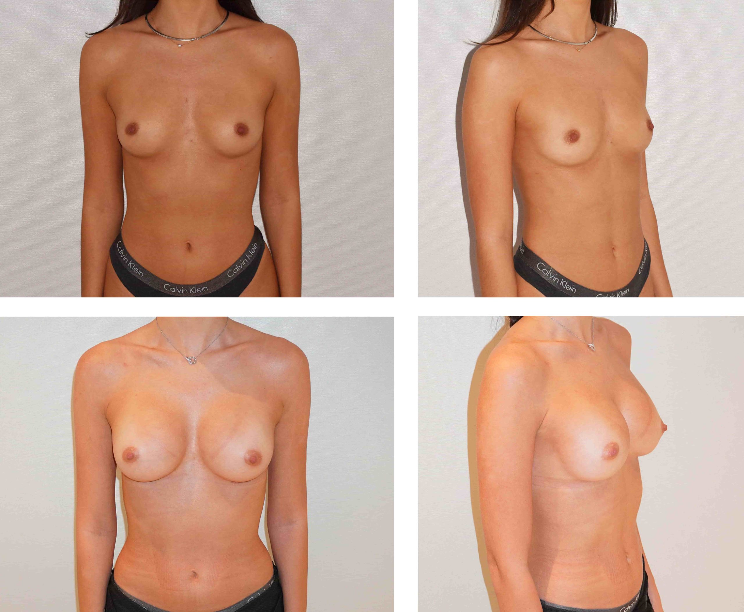 Before and after breast augmentation, case 1.