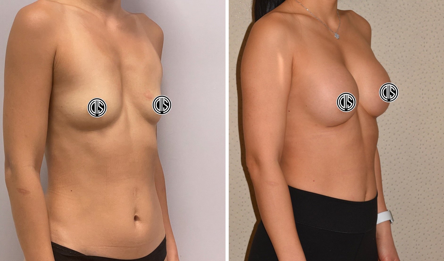 Before and after breast augmentation, case 2.