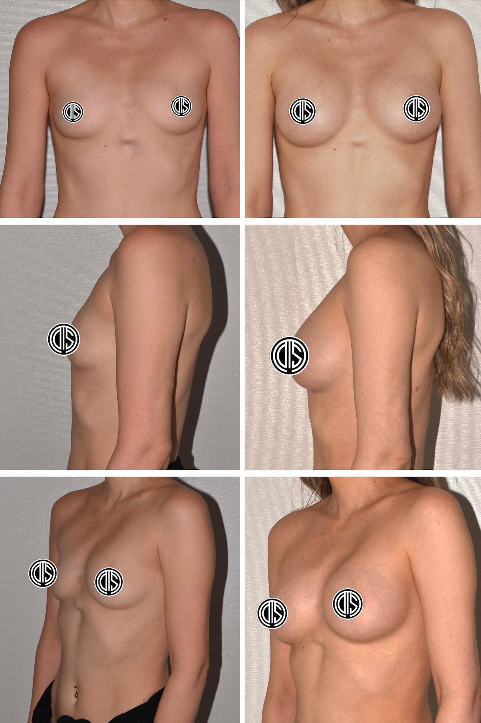 Before and after breast augmentation, case 3.