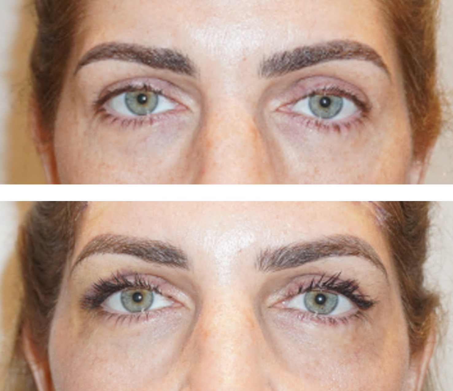 Before and after brow lift, case 1.