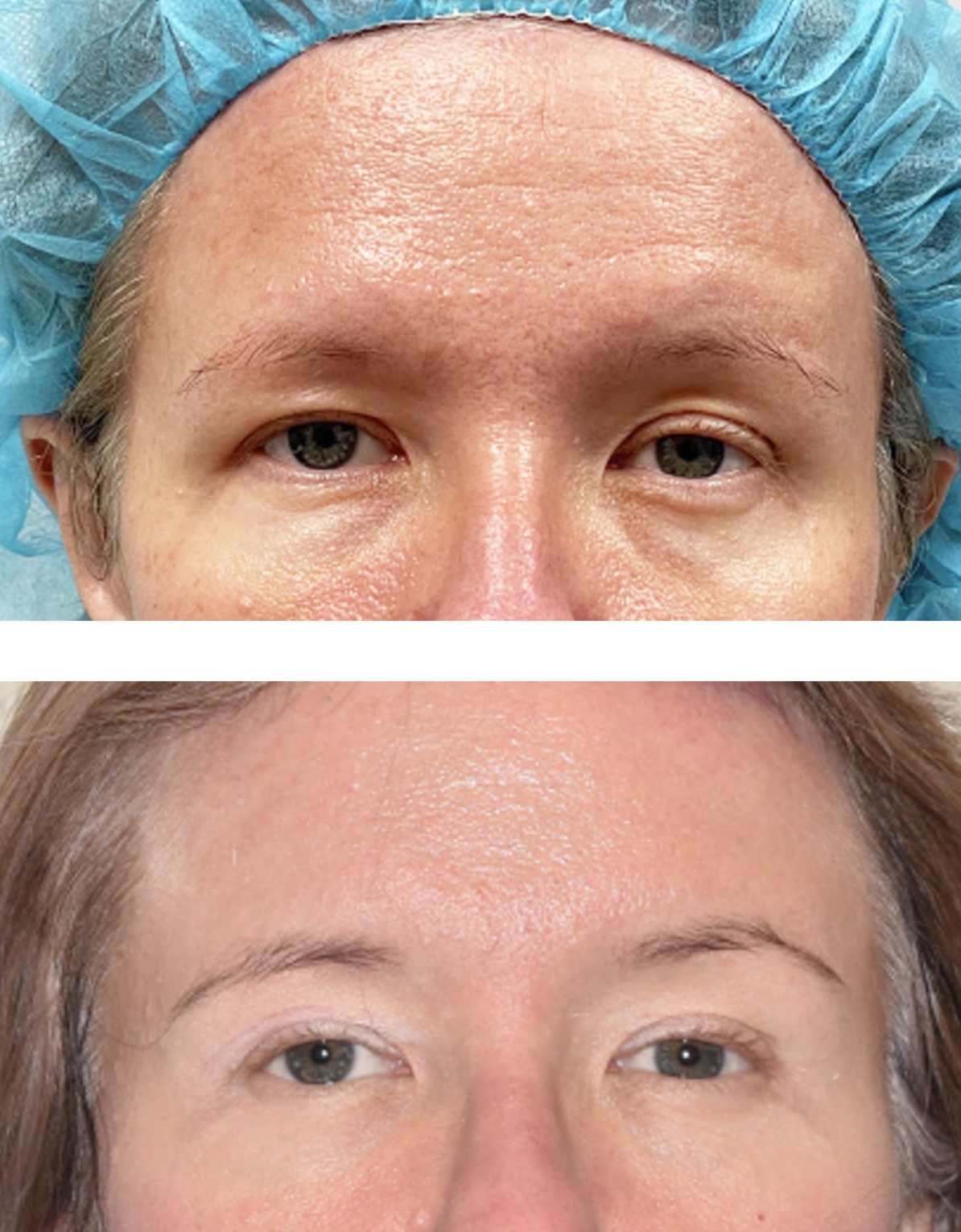 Before and after brow lift, case 2.