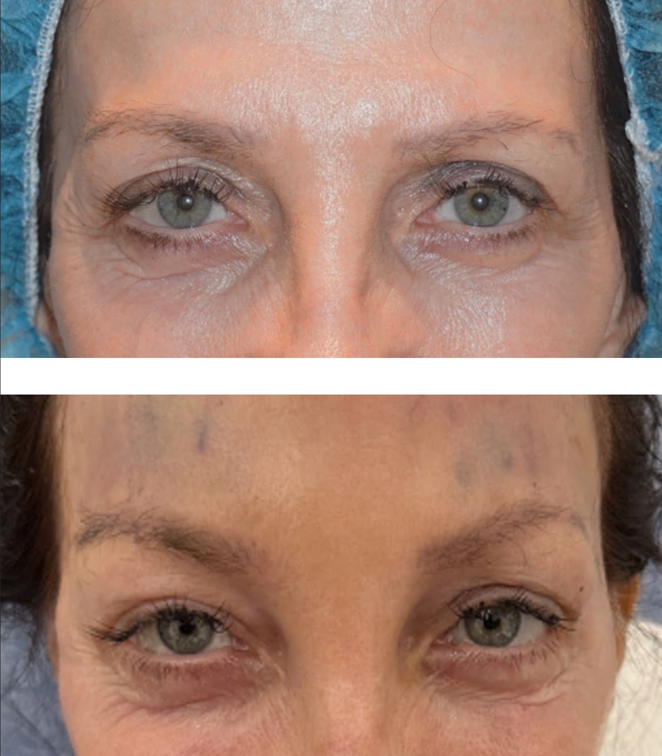 Before and after brow lift, case 3.