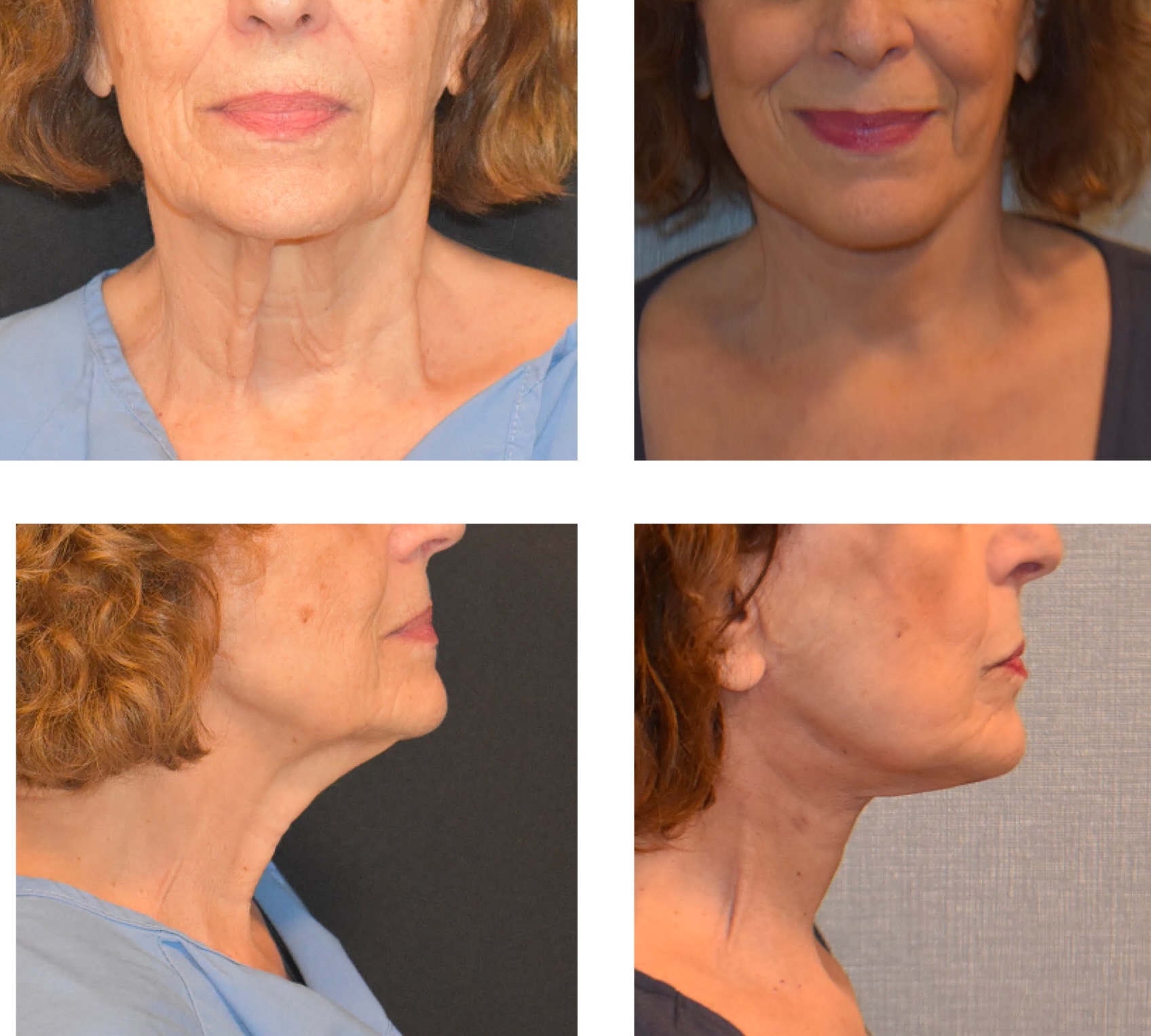 Before and after neck lift, case 1.