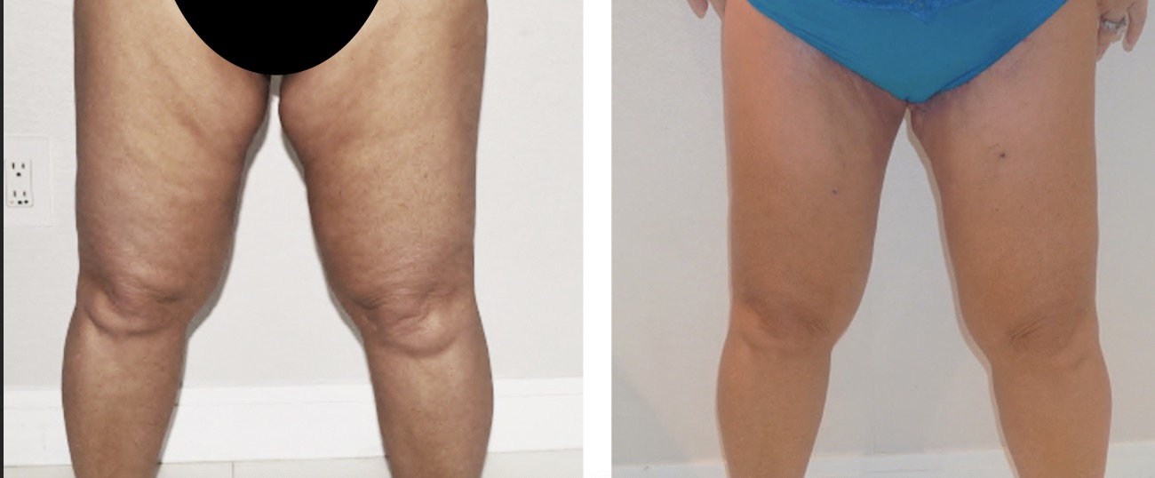 Before and after thigh lift, case 1.