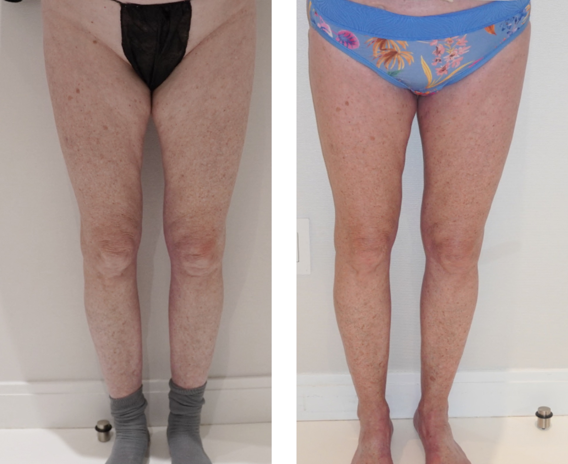 Before and after thigh lift, case 2.