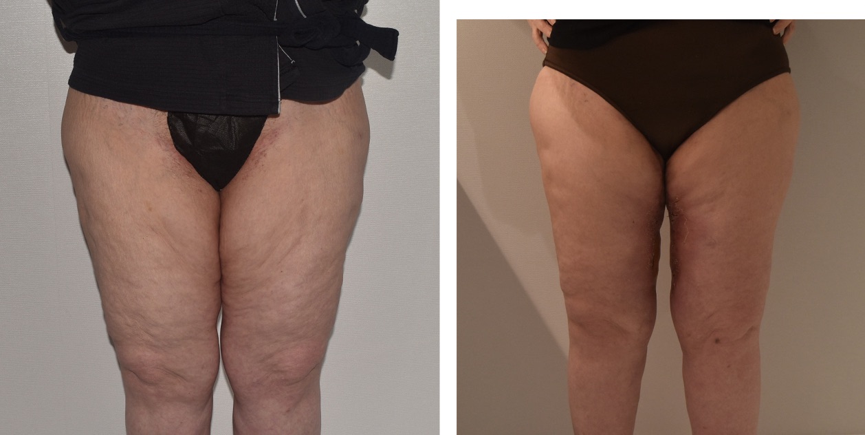 Before and after thigh lift, case 3.