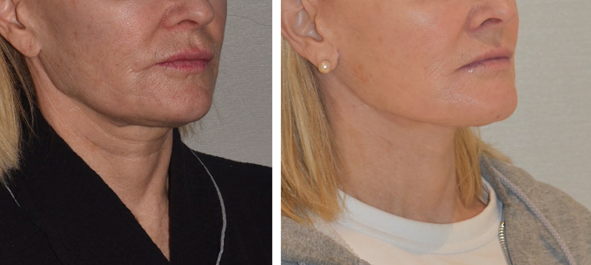 Before and after neck lift, case 2.