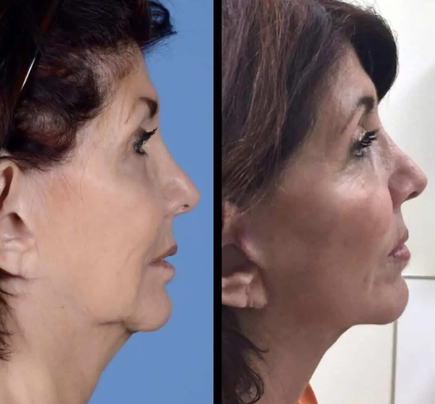 Before and after neck lift, case 3.